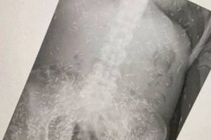 Viral, Jagat Maya Heboh Foto X-ray Perempuan Penuh Susuk