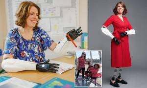 Gunakan Kaki dan Tangan Bionik, Guru Ini Kembali Mengajar di Sekolah