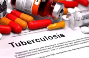 Tuberkulosis pada Anak dapat Dicegah, Lakukan Ini Sebelum Jadi Penyakit TB Berat