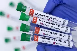 Cacar Monyet Bisa Menyebabkan Komplikasi, Salah Satunya Infeksi Paru